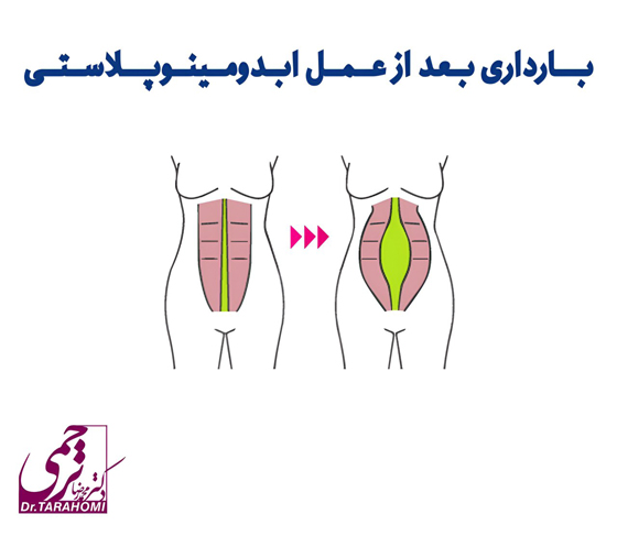 بارداری بعد از عمل ابدومینوپلاستی