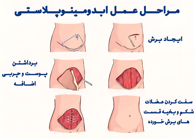 مراحل عمل ابدومینوپلاستی