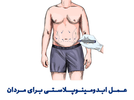 جراحی ابدومینوپلاستی برای مردان