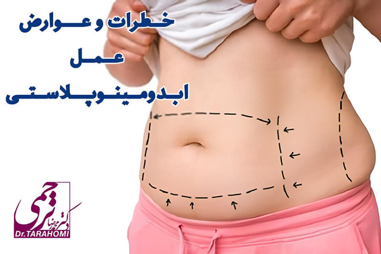 خطرات و عوارض جراحی آبدومینوپلاستی