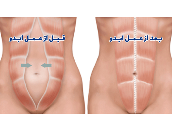 عمل جراحی ابدومینوپلاستی چقدر طول میکشد