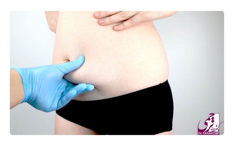 زمان مناسب برای بارداری بعد از عمل ابدومینوپلاستی