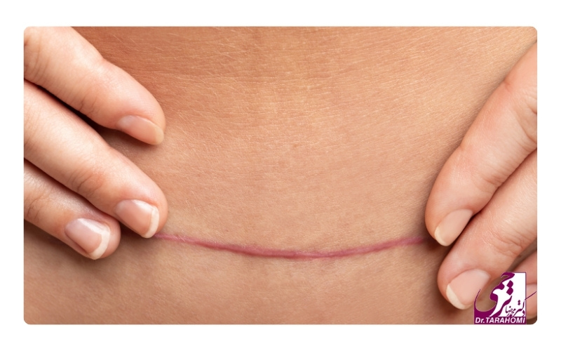 مشکلات عمل سزارین بعد از ابدومینوپلاستی