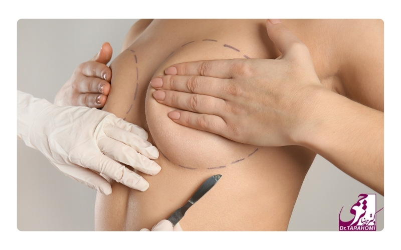 هرینه بهترین جراح لیفت سینه در تهران چقدر است