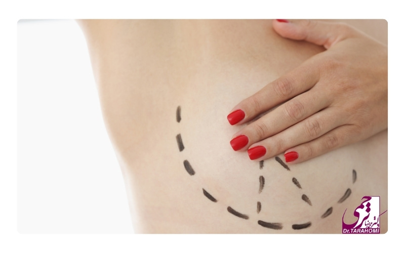 ویژگی های بهترین دکتر لیفت سینه در تهران