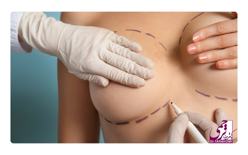 بهترین جراح لیفت سینه در تهران کیست