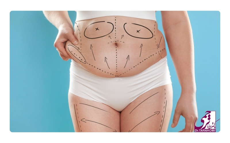 آیا امکان بازگشت شکم بعد از ابدومینوپلاستی وجود دارد