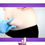 دلایل برگشت شکم بعد از ابدومینوپلاستی