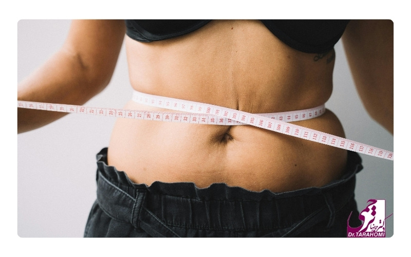 رعایت نکردن مراقبت‌های بعد از جراحی منجر به برگشت شکم بعد از ابدومینوپلاستی