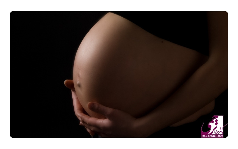 بارداری بعد از ابدومینوپلاستی از دلایل بازگشت شکم