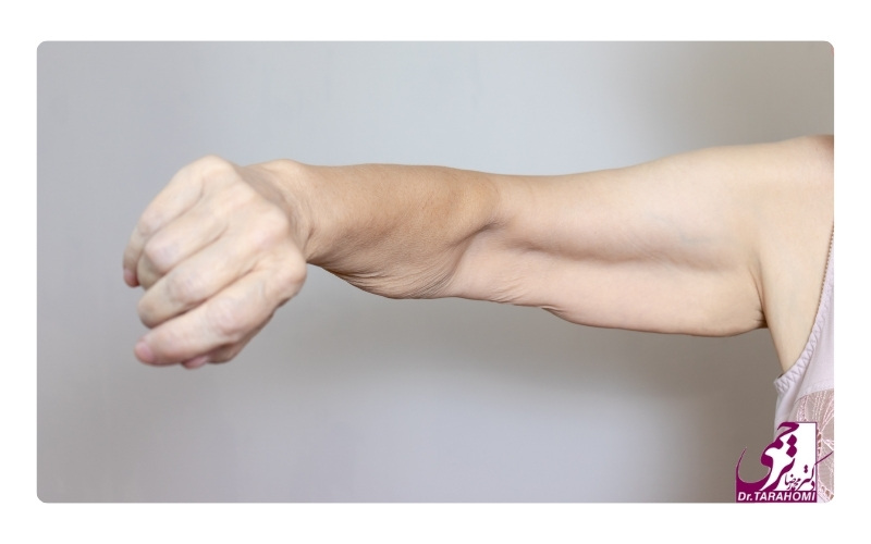 چه افرادی به لیفت بازو نیاز دارند