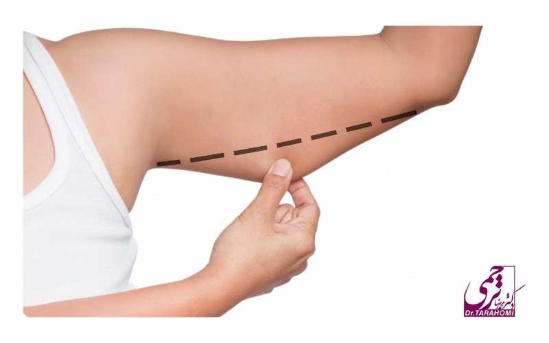 لیفت بازو چیست