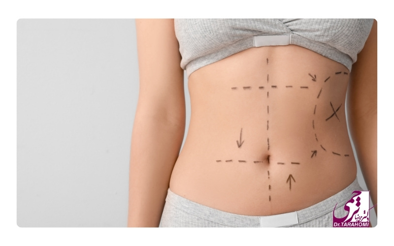 نکات مهم بعد از لیپوماتیک ساعت شنی