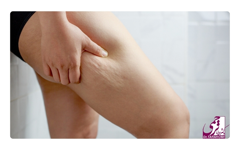 مزایای عمل لیفت ران