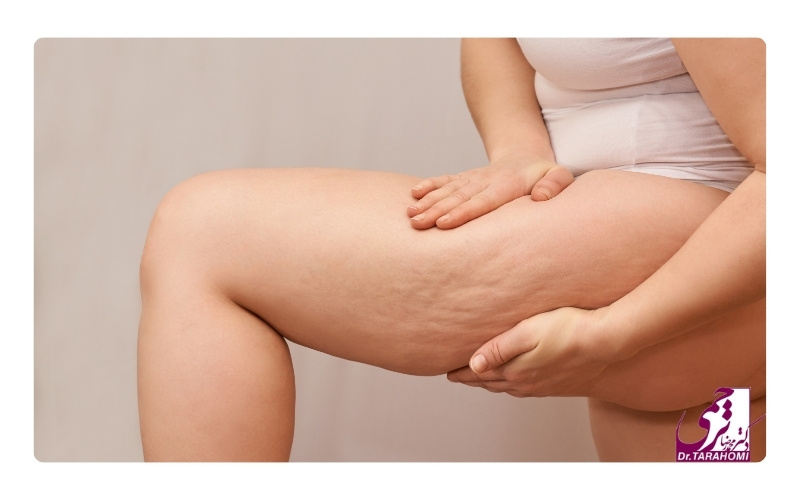 چه افرادی به لیفت ران نیاز دارند