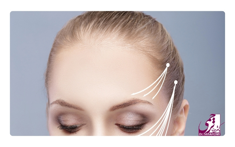 لیفت اندوسکوپیک ابرو چگونه انجام می‌شود