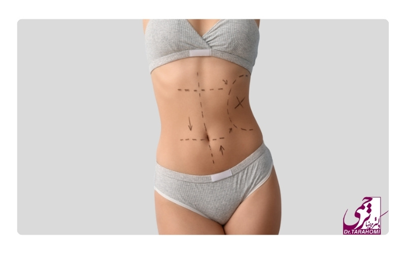 هزینه ابدومینوپلاستی در بیمارستان دولتی