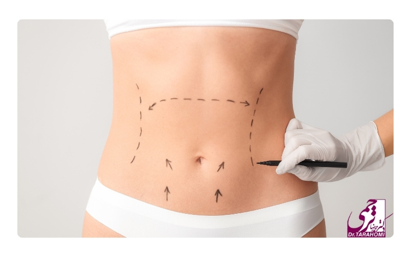 هزینه جراحی ترکیبی لیپوساکشن و ابدومینوپلاستی
