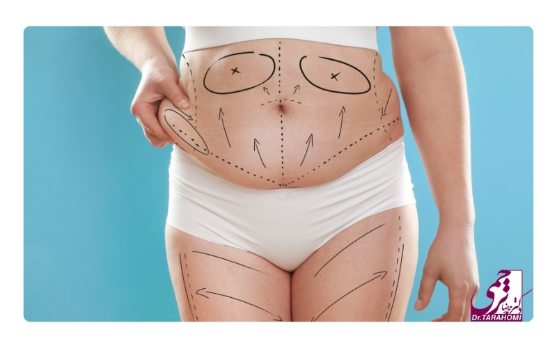 عوامل موثر در قیمت عمل ابدومینوپلاستی