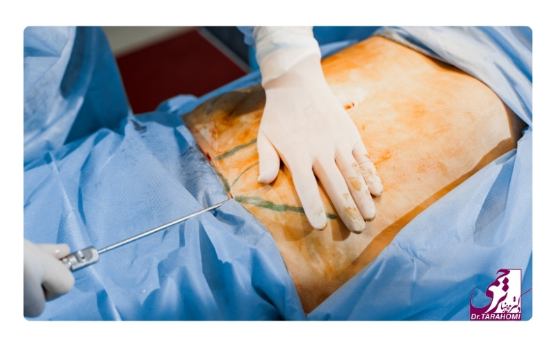 هزینه عمل ابدومینوپلاستی