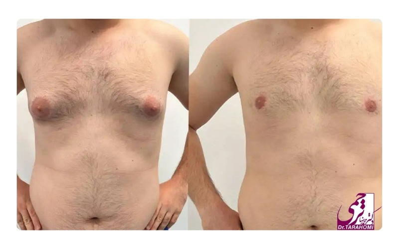 تشخیص ژنیکوماستی خفیف