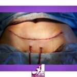 جای بخیه ابدومینوپلاستی چگونه است؟