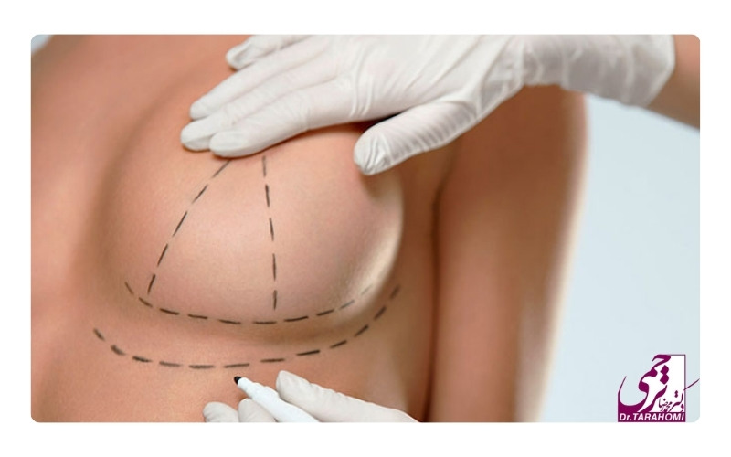 مدت زمان ایجاد برش و اصلاح فرم سینه در عمل لیفت سینه