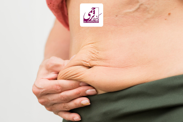پیشگیری از افتادگی پوست شکم