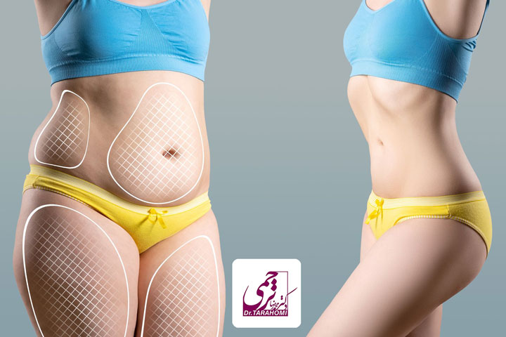 لیپوماتیک چگونه باعث کاهش چربی میشود