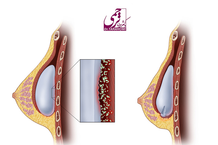 دلایل پارگی پروتز سینه