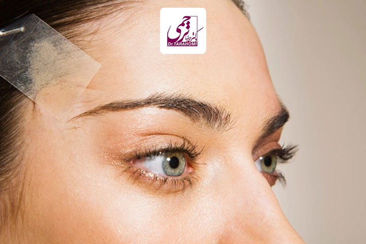 تفاوت لیفت ابرو و شقیقه در ماندگاری نتایج