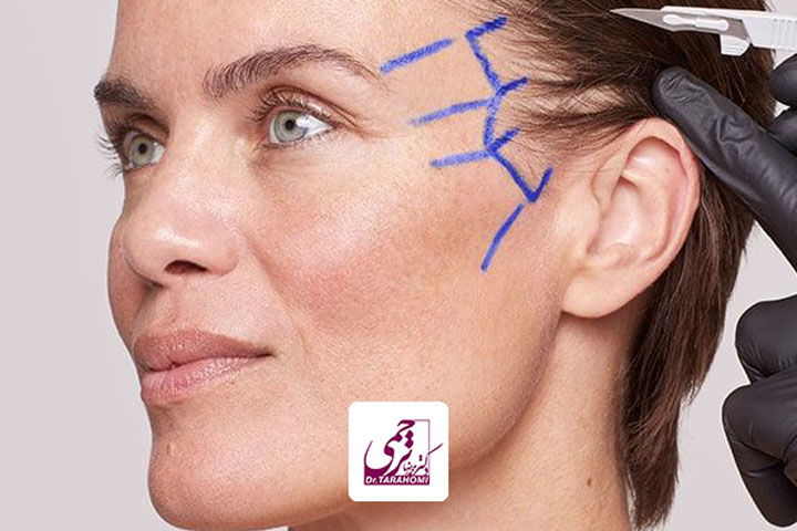 لیفت ابرو یا لیفت شقیقه کدام مناسب ما است؟