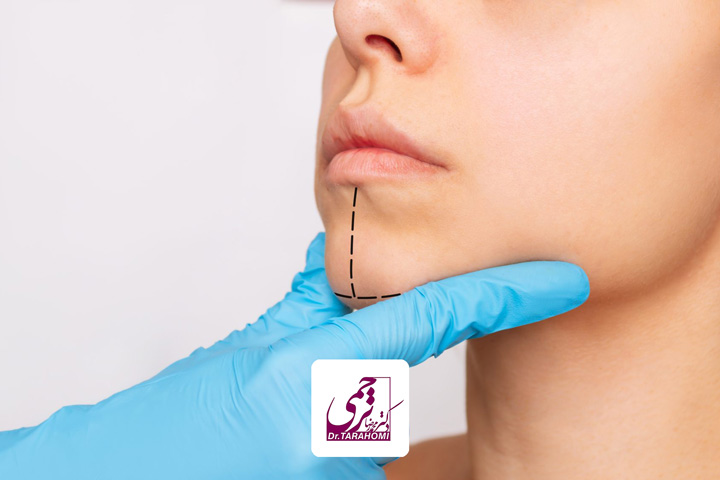 عوامل موثر بر هزینه عمل جراحی چانه